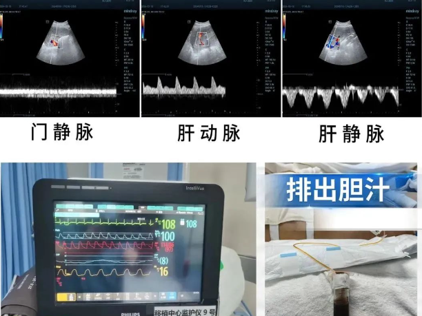 经科技查新属世界首例——西京医院成功将基因编辑猪肝植入人体